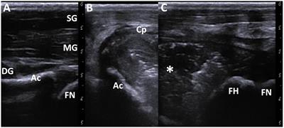 Case report: Imaging of septic arthritis in the hip joint of a calf treated with femoral head ostectomy